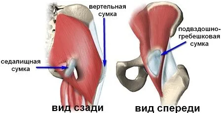 ніж лікувати бурсит тазостегнового суглоба
