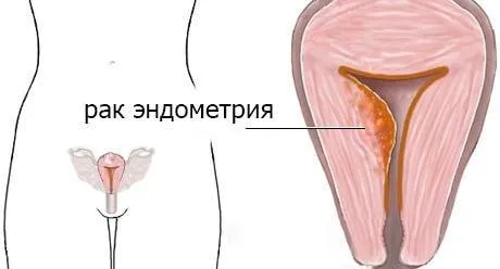 Рак ендометрія: причини, ознаки, симптоми, лікування передраку рак ендометрій передрак матка жінки клімакс узі естроген причини симптоми лікування