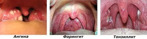 як лікувати абсцес гланд