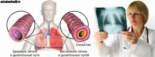 запалення легенів симптоми