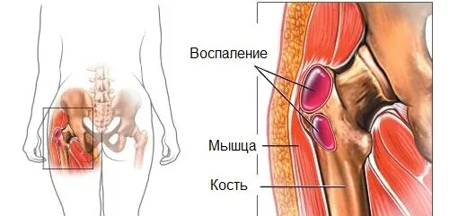 ніж лікувати бурсит тазостегнового суглоба