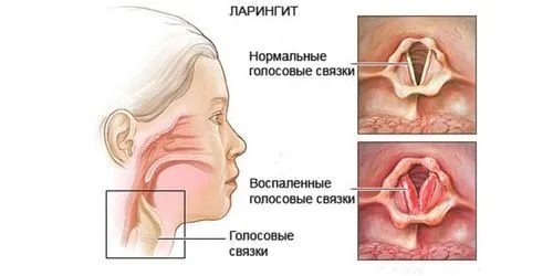 можна вилікувати хронічний ларингіт