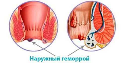 вилікувати зовнішній геморой