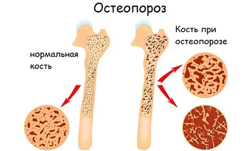 як лікувати ревматизм ніг