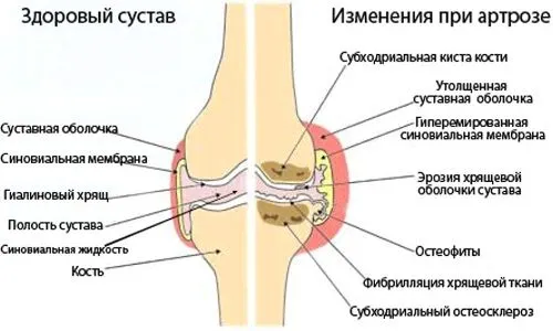як лікувати ревматизм ніг