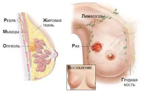 як лікувати рак 2 ступеня