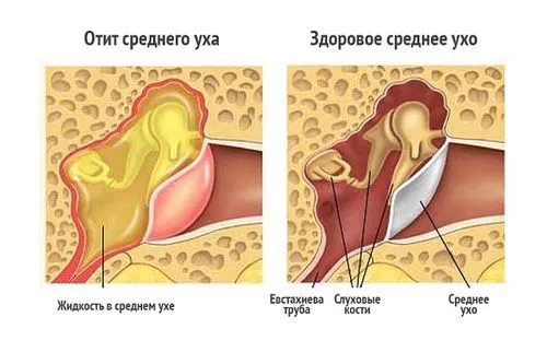 Антибіотики при отиті у дорослих як лікувати отит без антибіотиків