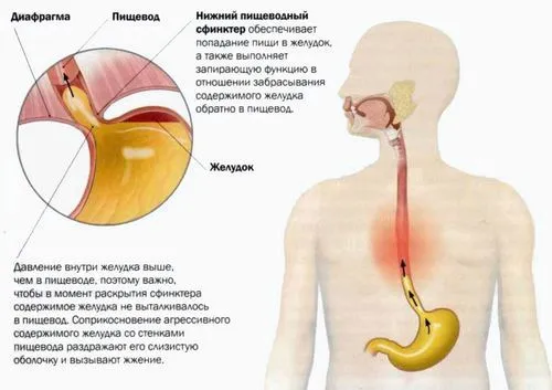 Печіння в шлунку: як будемо лікувати? як лікувати печіння в шлунку