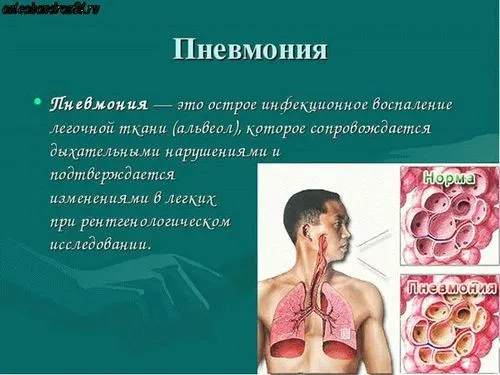 запалення легенів симптоми у дітей