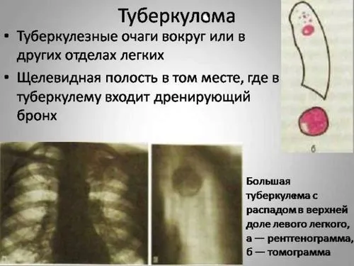 як лікувати туберкулема легких