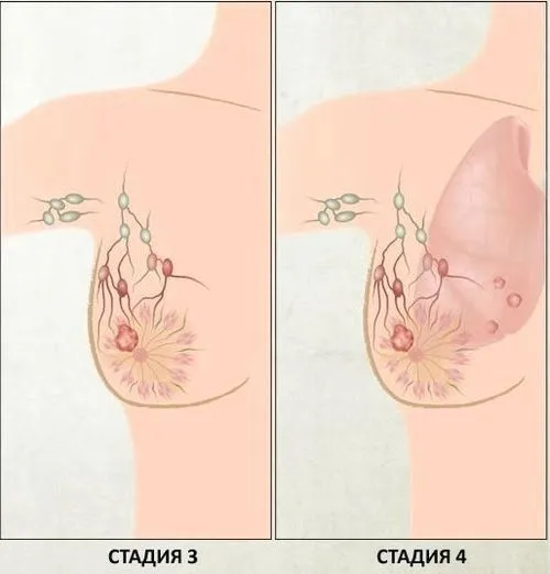 як лікувати рак 2 ступеня