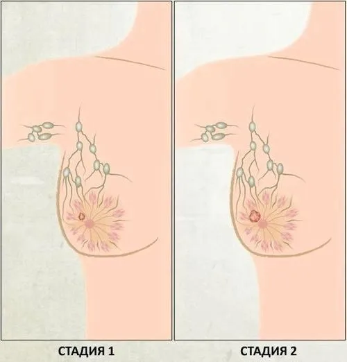 як лікувати рак 2 ступеня