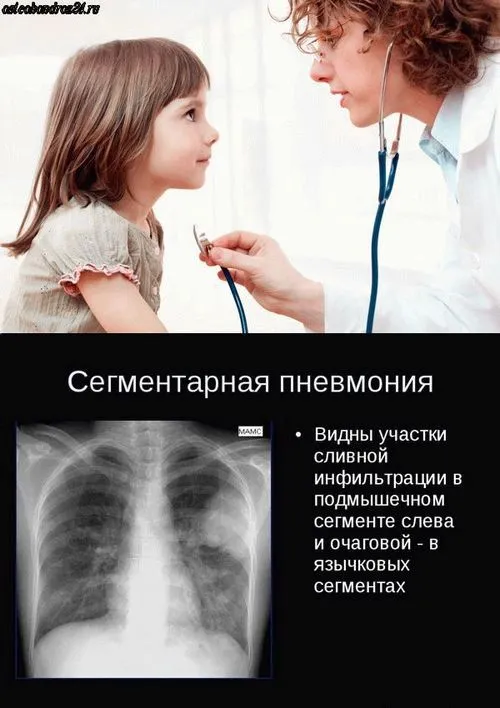 запалення легенів лікування