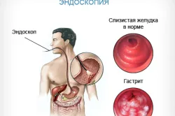 лікування гастриту