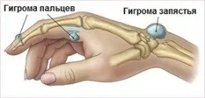 інші хвороби суглобів