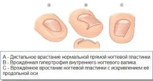 як позбутися від врослого нігтя на нозі