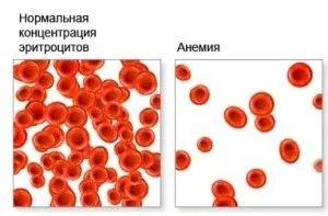 Лікування анемії як лікувати анемію крові