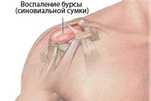 Підлопаткова бурсит і його лікування як лікувати бурсит лопатки