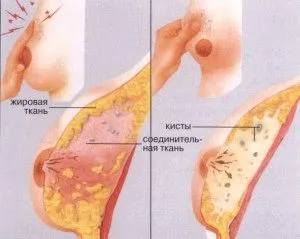 вилікувати мастопатію домашніх умовах