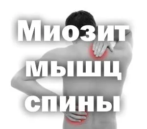 Міозит м'язів спини: симптоми, причини і лікування різних форм запалення як лікувати м'язи спини