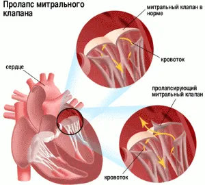Лікування анемії як лікувати анемію крові