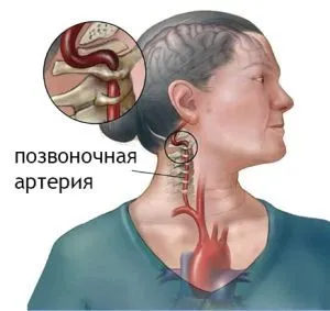 задній шийний симпатичний синдром