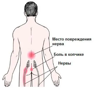 якщо не лікувати радикуліт