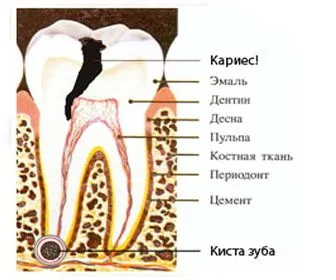 як лікувати кісту зуба