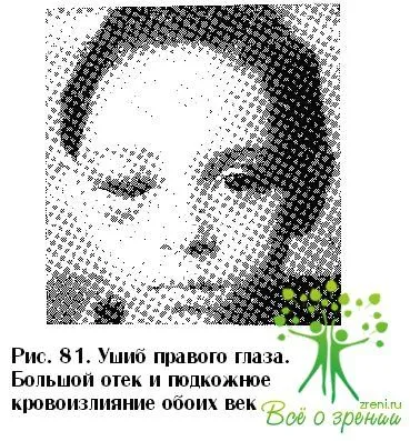 крововиливи