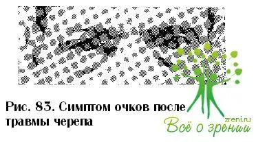 контузії