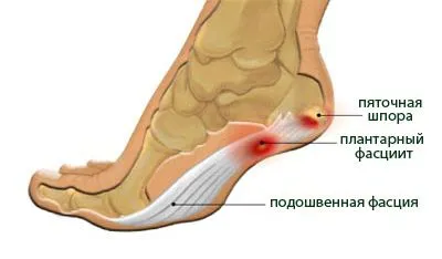 як лікувати розрив фасції