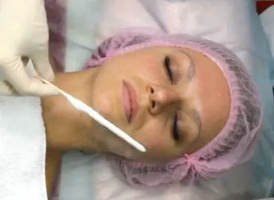 як лікувати демодекоз волосистої частини голови
