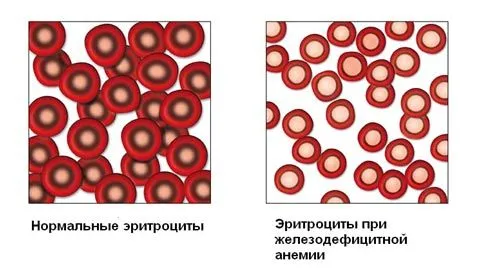 як лікувати анемію без ліків