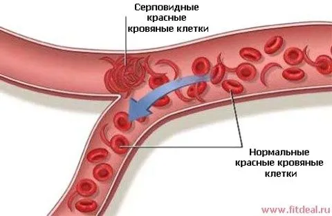 лікування анемії