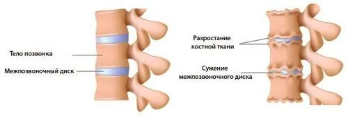 як лікувати хондроз попереку