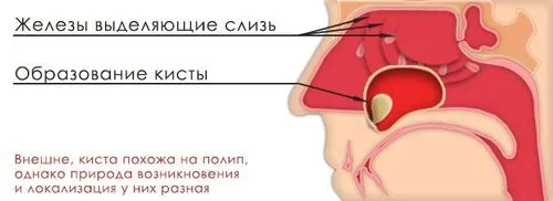 як лікувати кісту гайморової пазухи