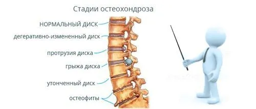 як лікувати остеохондроз на ранній стадії