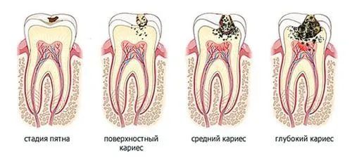 Прихований карієс як лікувати прихований карієс