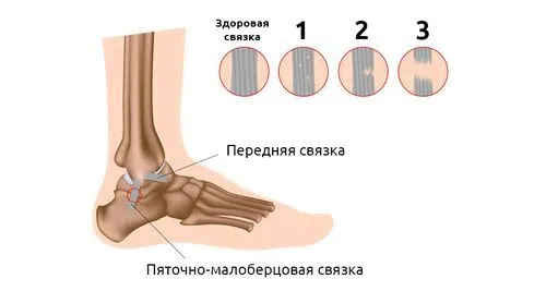 як лікувати розтягнення гомілковостопного суглоба