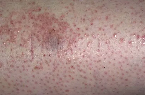 як лікувати пелюшковий дерматит народними засобами