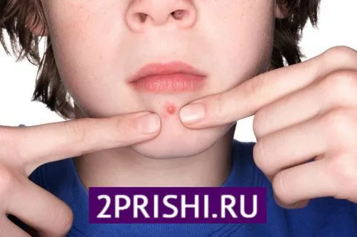 Прищі на підборідді у чоловіків: причини появи як лікувати прищі на бороді