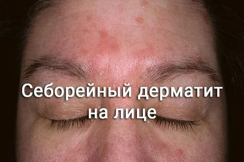 Себорейний дерматит на обличчі: способи лікування як лікувати себорейний дерматит на обличчі