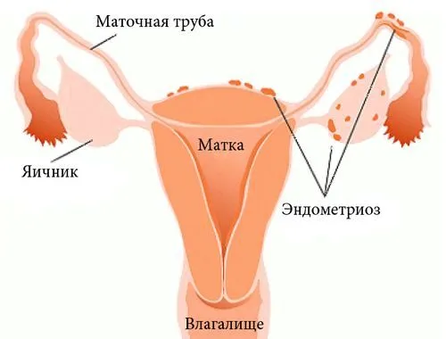як вилікувати зовнішній ендометріоз