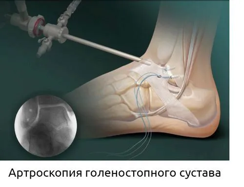 як лікувати розтягнення гомілковостопного суглоба