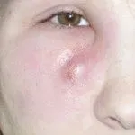 Як лікувати фурункул на обличчі фурункули на обличчі причини