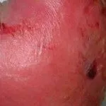 як лікувати хворобу рожа на ногах