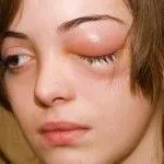як лікувати хворобу рожа на ногах