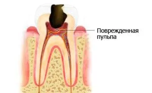 лікувати карієс не боляче
