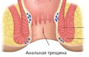 як вилікувати анальну тріщину