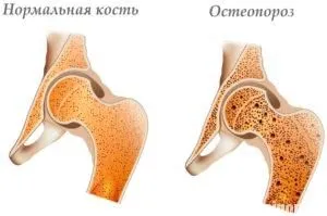 як лікувати остеопороз стегна